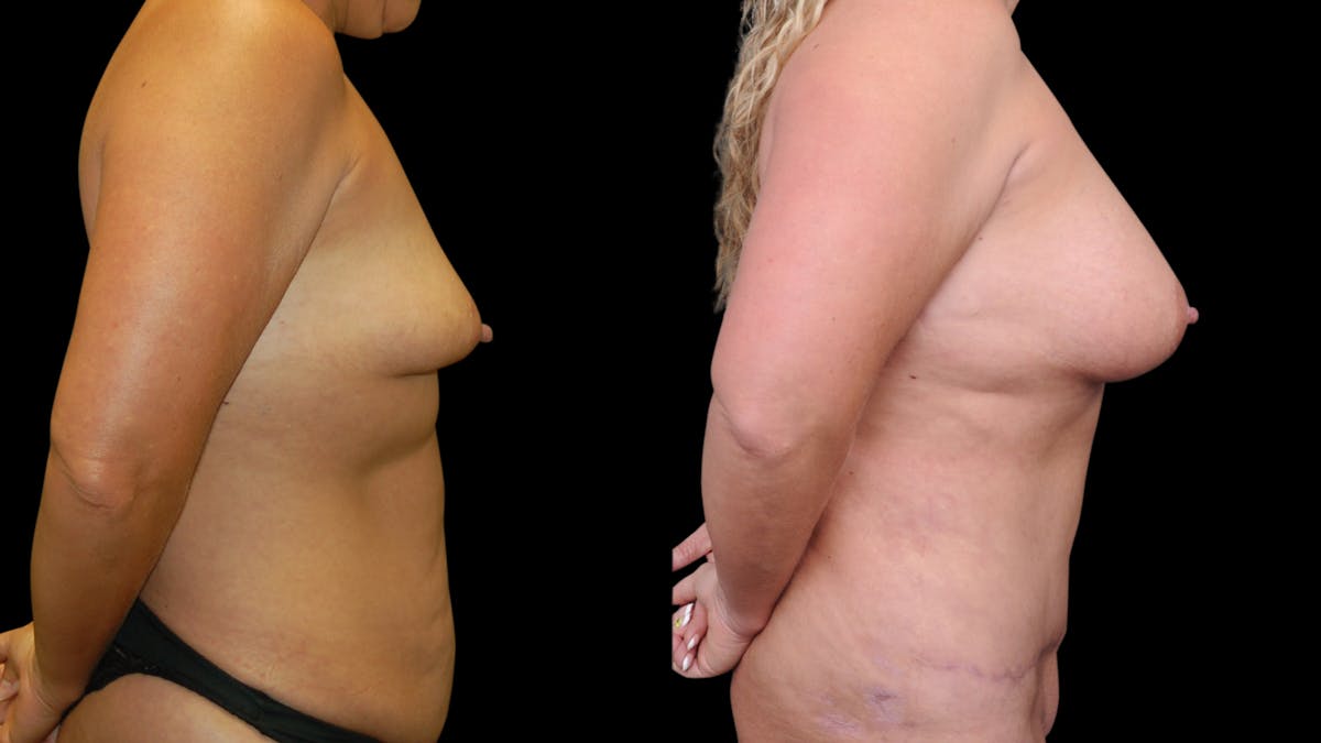 Mommy Makeover Before & After Gallery - Patient 358824 - Image 5