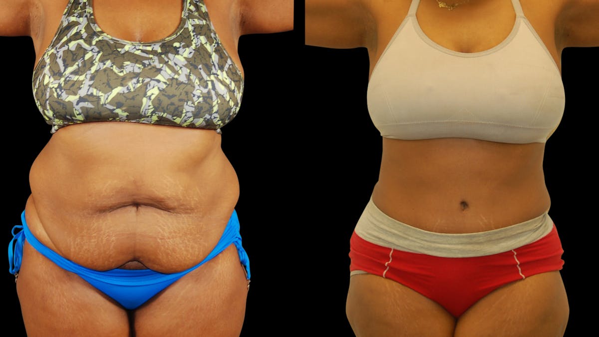 Tummy Tuck