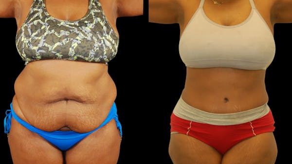 Tummy Tuck Before & After Gallery - Patient 384375 - Image 1