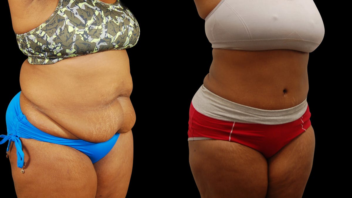 Tummy Tuck Before & After Gallery - Patient 384375 - Image 2