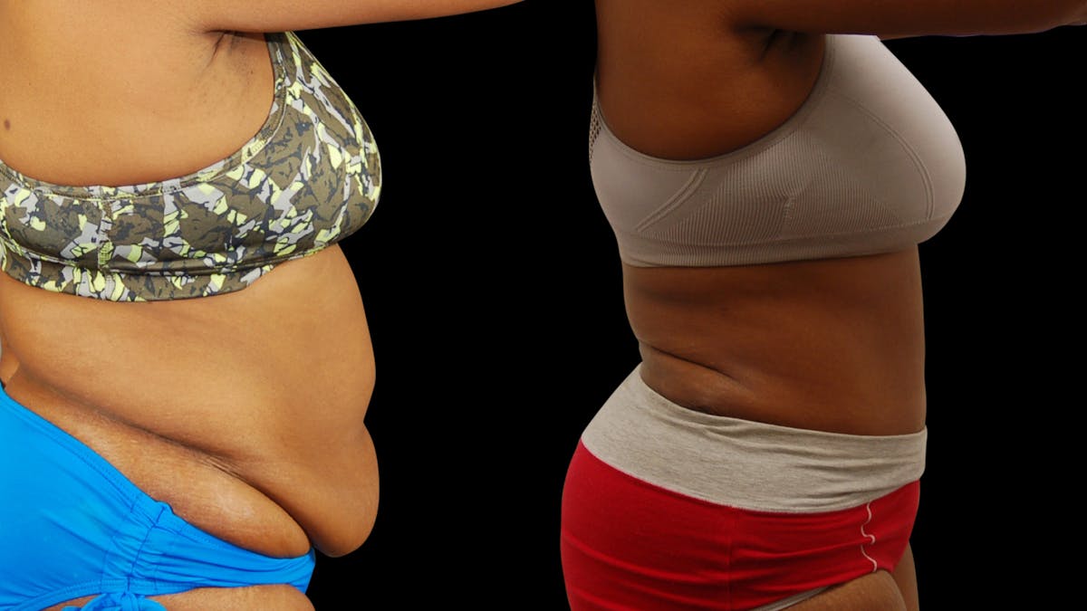 Tummy Tuck Before & After Gallery - Patient 384375 - Image 3
