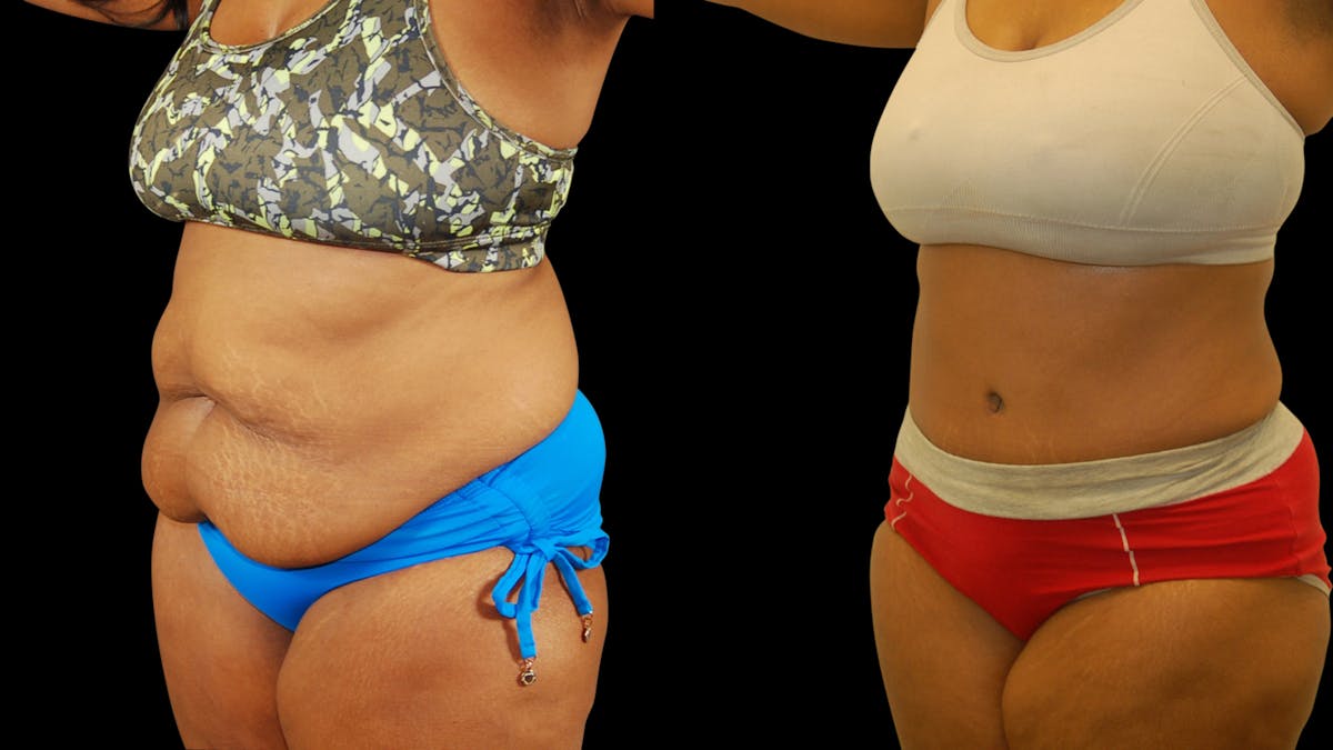 Tummy Tuck Before & After Gallery - Patient 384375 - Image 4