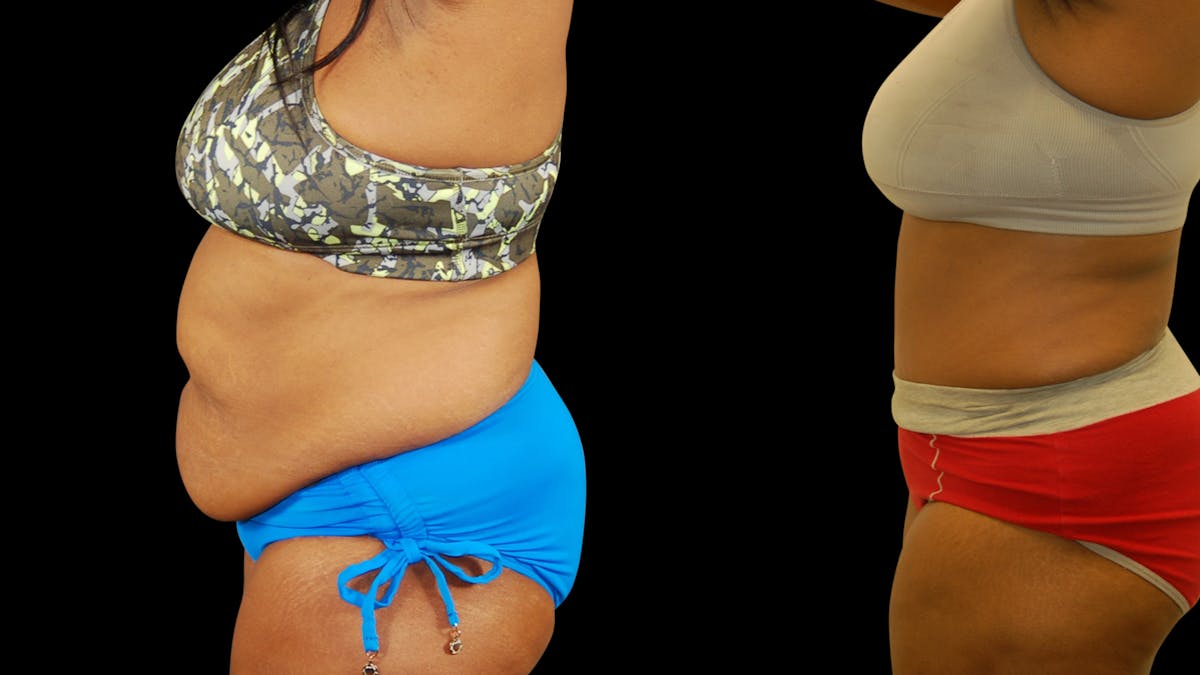 Tummy Tuck Before & After Gallery - Patient 384375 - Image 5