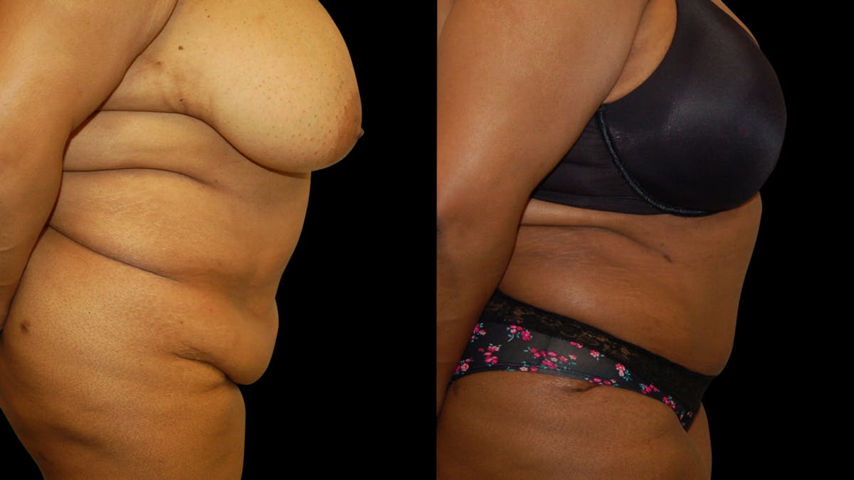 Tummy Tuck Before & After Gallery - Patient 374268 - Image 2