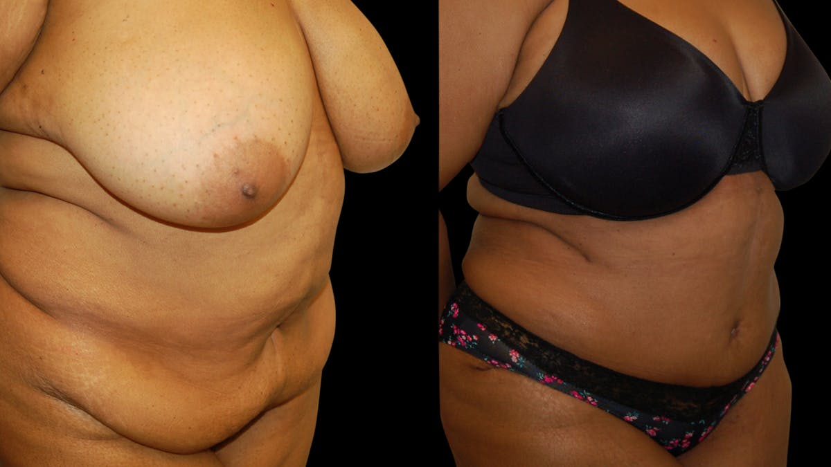 Tummy Tuck Before & After Gallery - Patient 374268 - Image 3