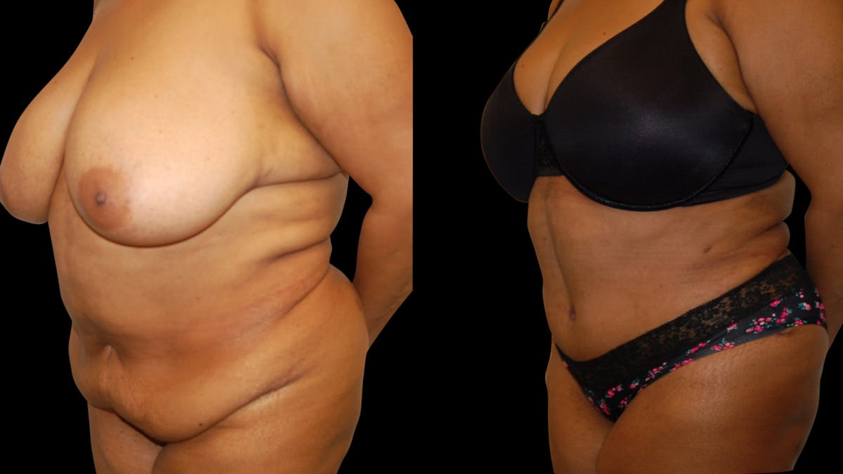 Tummy Tuck Before & After Gallery - Patient 374268 - Image 4
