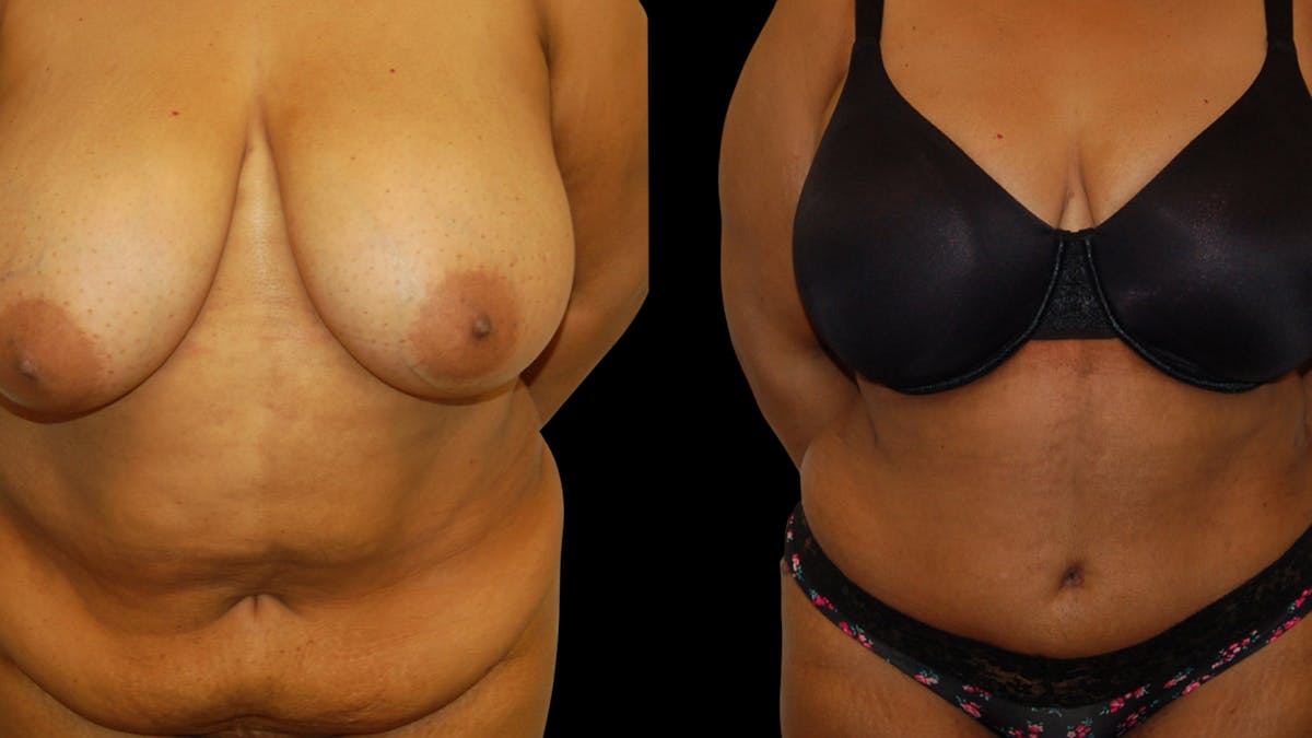 Tummy Tuck Before & After Gallery - Patient 374268 - Image 1