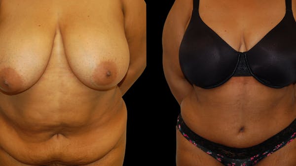 Tummy Tuck Before & After Gallery - Patient 374268 - Image 1