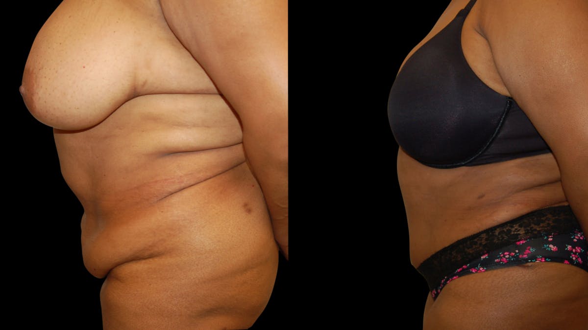 Tummy Tuck Before & After Gallery - Patient 374268 - Image 5