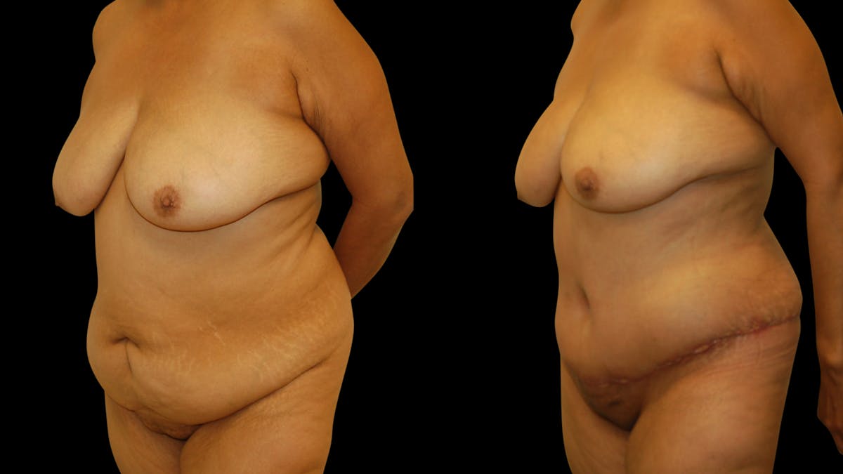 Tummy Tuck Before & After Gallery - Patient 302857 - Image 2