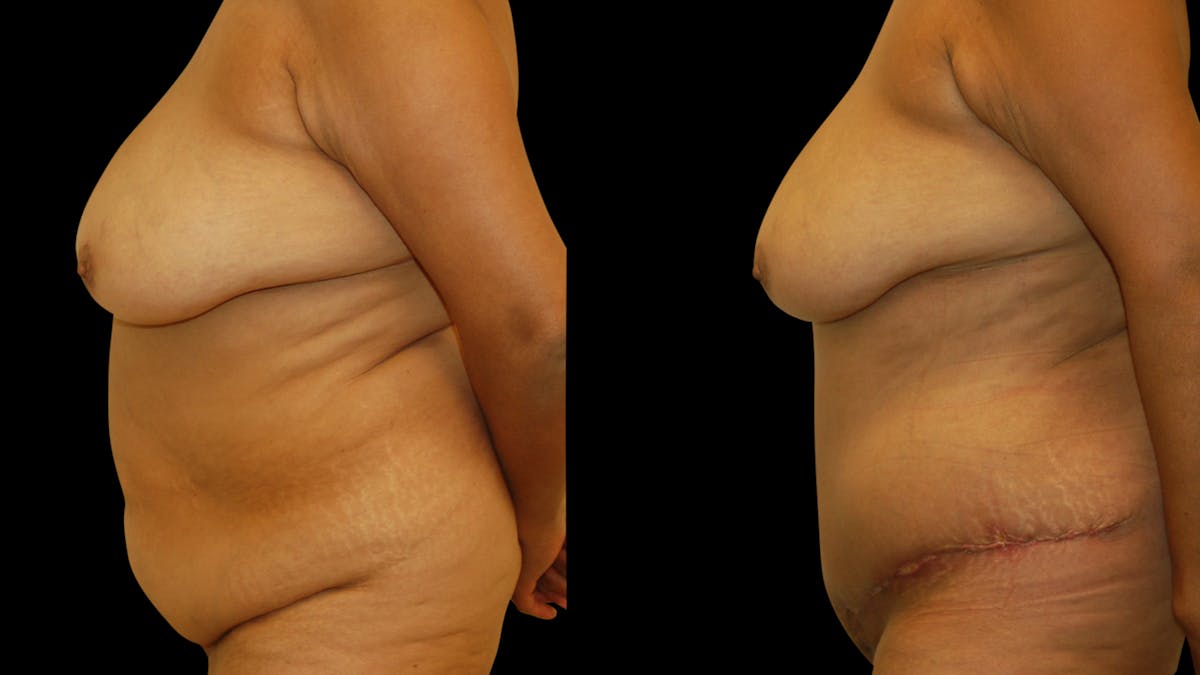 Tummy Tuck Before & After Gallery - Patient 302857 - Image 3