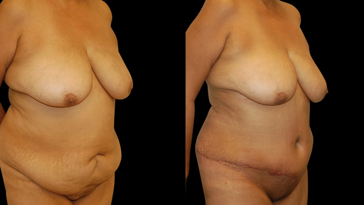 Tummy Tuck Before & After Gallery - Patient 302857 - Image 4