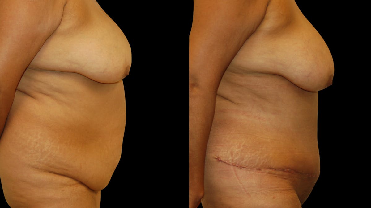 Tummy Tuck Before & After Gallery - Patient 302857 - Image 5
