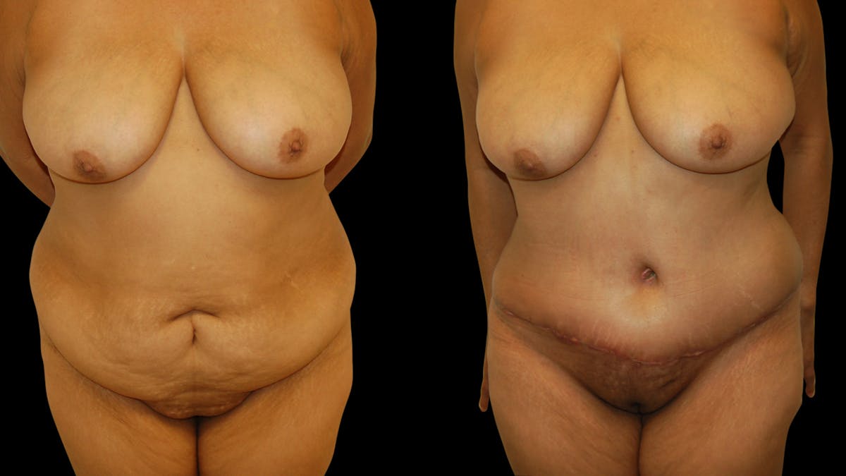 Tummy Tuck Before & After Gallery - Patient 302857 - Image 1