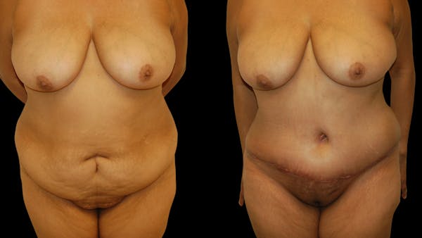Tummy Tuck Before & After Gallery - Patient 302857 - Image 1