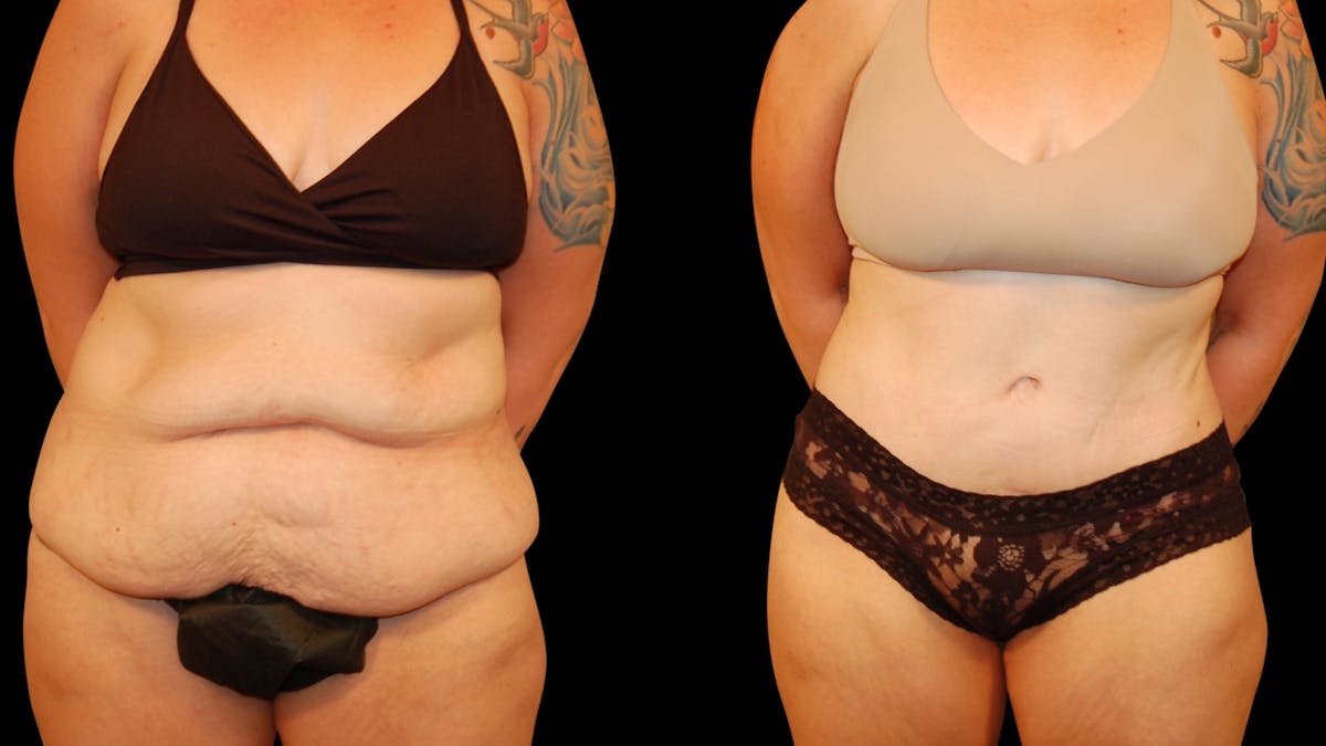 Tummy Tuck Before & After Gallery - Patient 162658 - Image 1