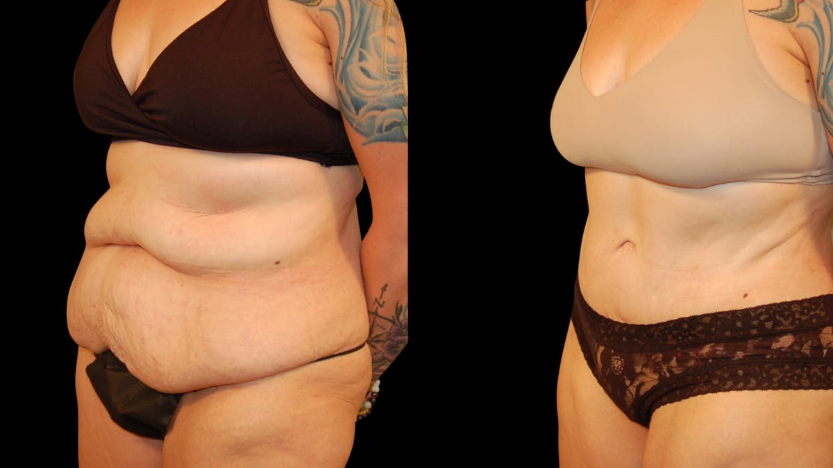 Tummy Tuck Before & After Gallery - Patient 162658 - Image 2