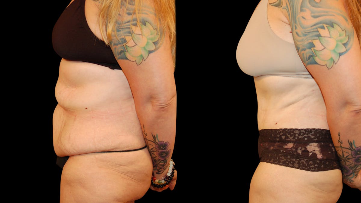 Tummy Tuck Before & After Gallery - Patient 162658 - Image 3