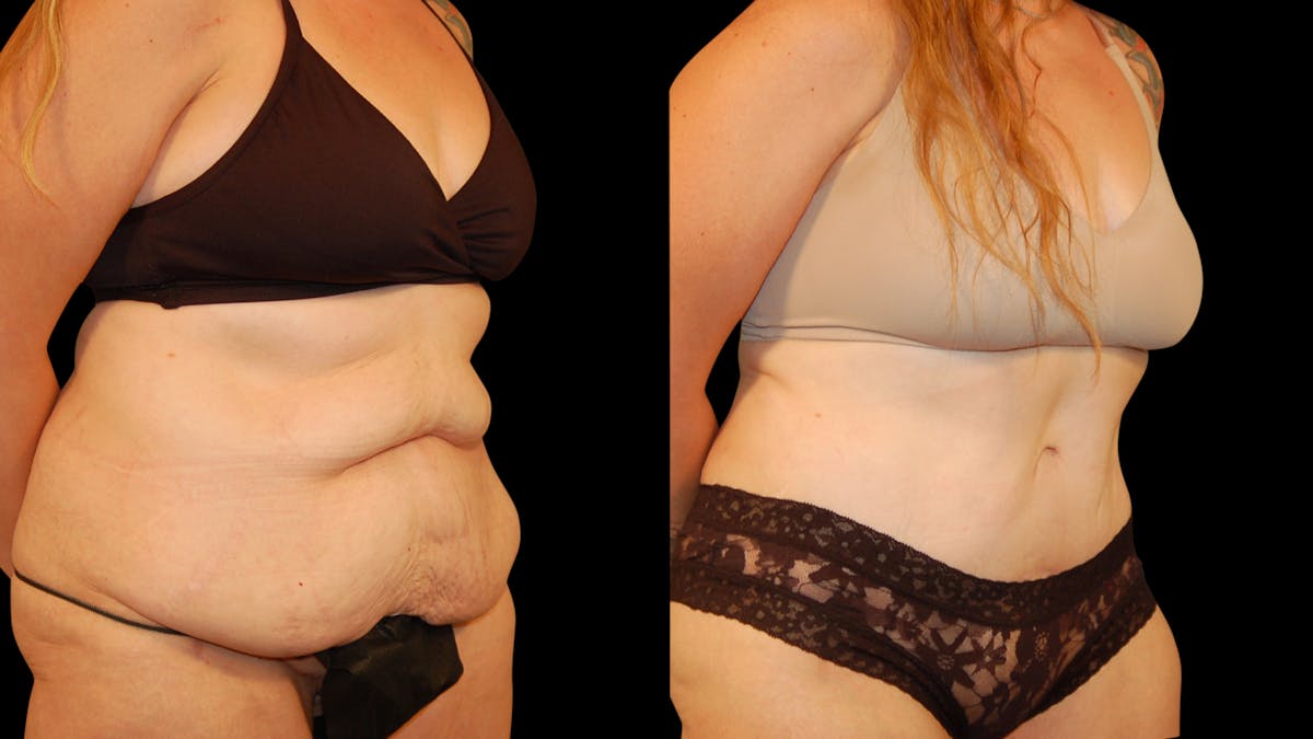 Tummy Tuck Before & After Gallery - Patient 162658 - Image 4