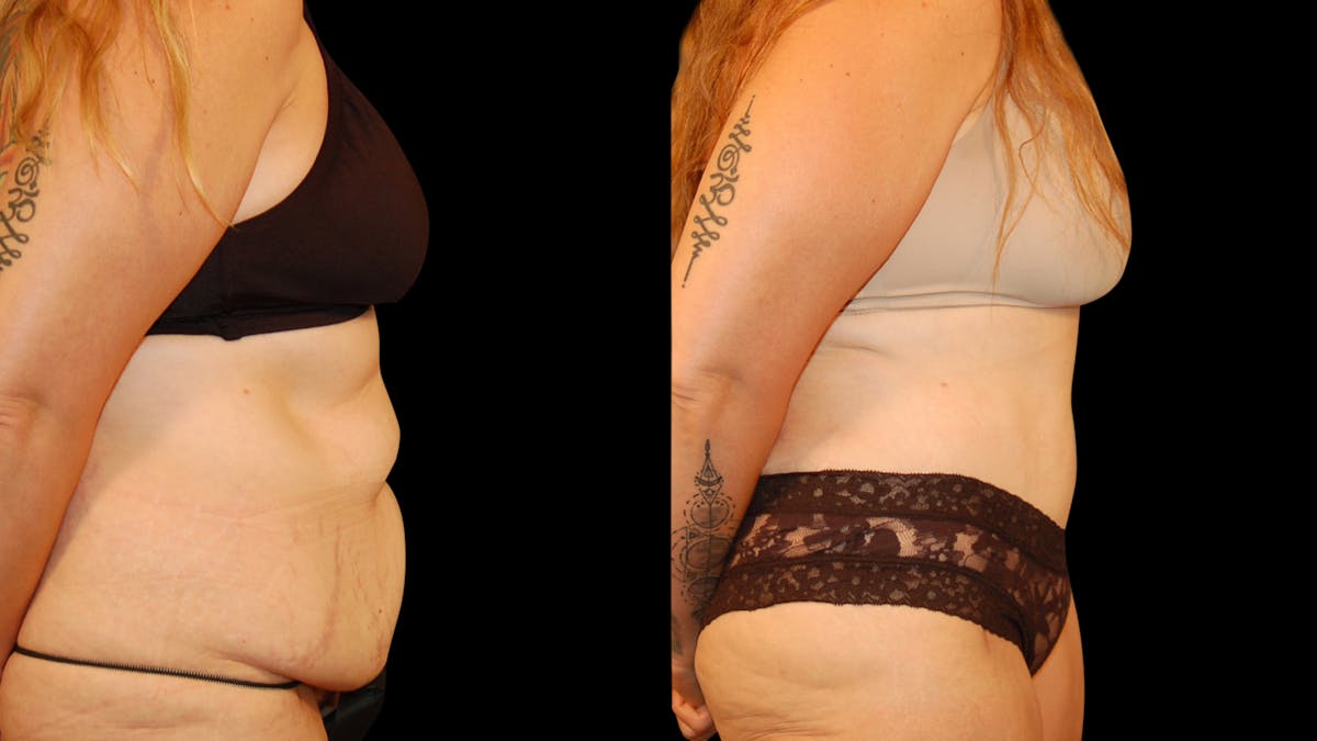 Tummy Tuck Before & After Gallery - Patient 162658 - Image 5
