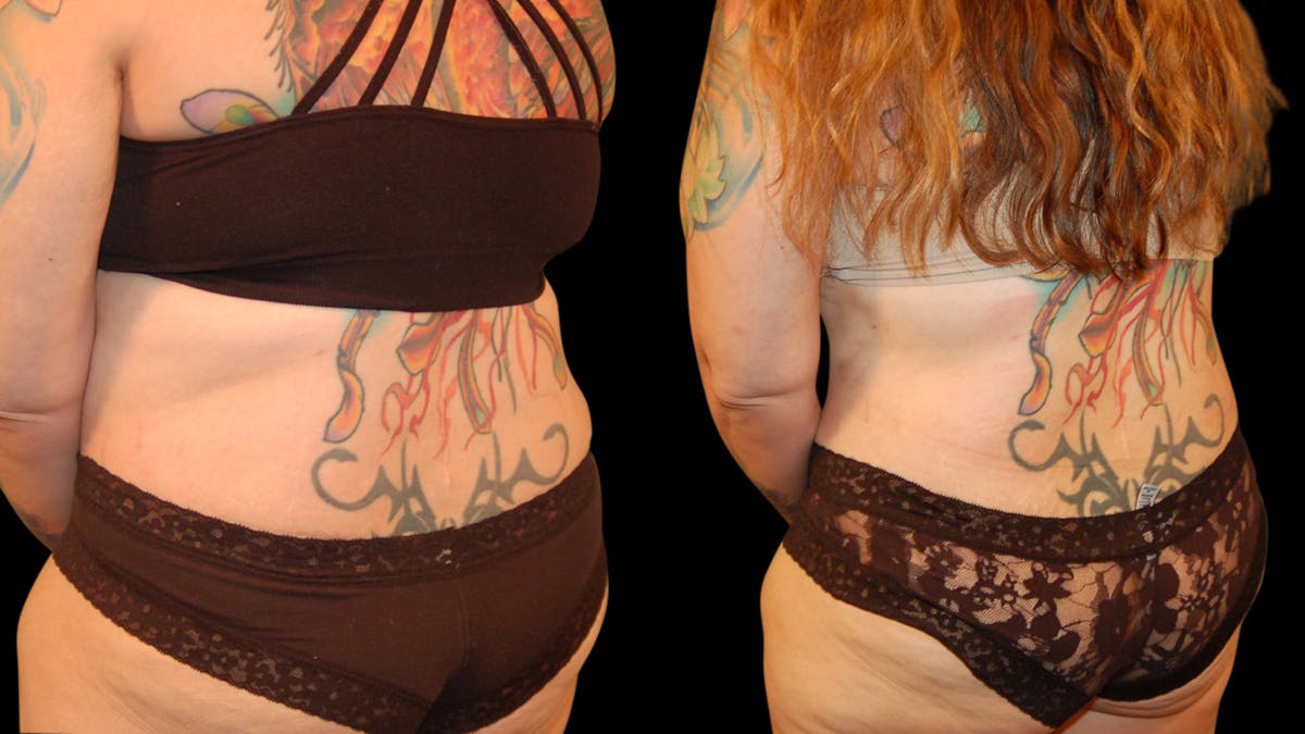Tummy Tuck Before & After Gallery - Patient 162658 - Image 6