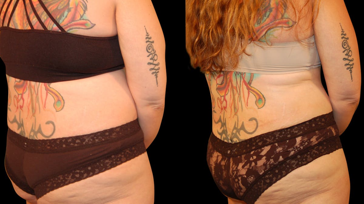 Tummy Tuck Before & After Gallery - Patient 162658 - Image 7