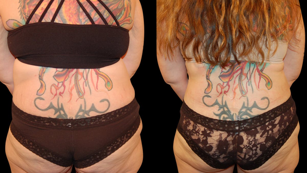 Tummy Tuck Before & After Gallery - Patient 162658 - Image 8