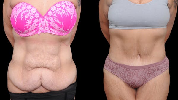 Tummy Tuck Before & After Gallery - Patient 379329 - Image 1