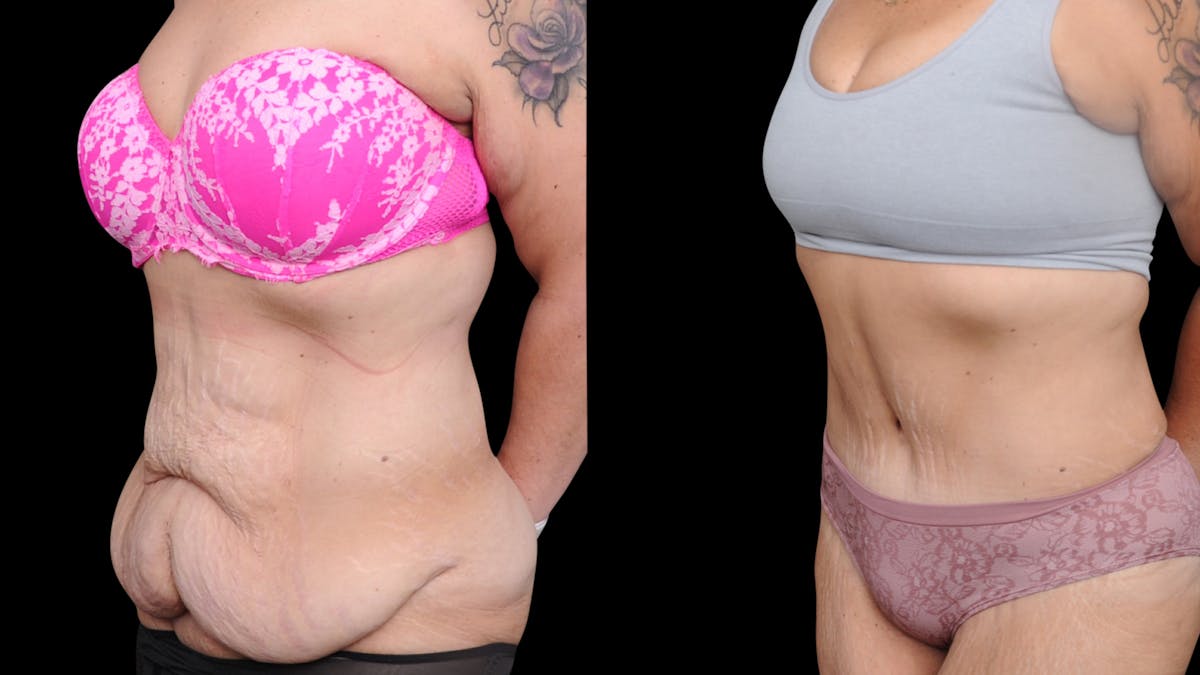 Tummy Tuck Before & After Gallery - Patient 379329 - Image 2