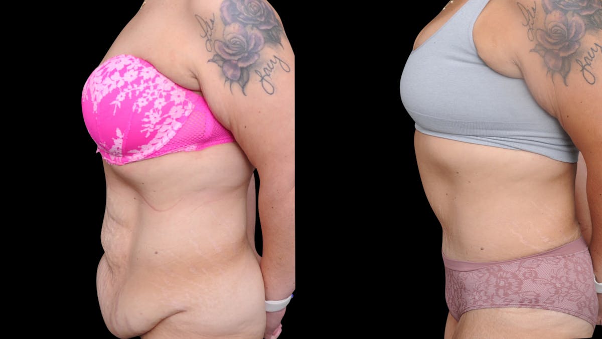 Tummy Tuck Before & After Gallery - Patient 379329 - Image 3