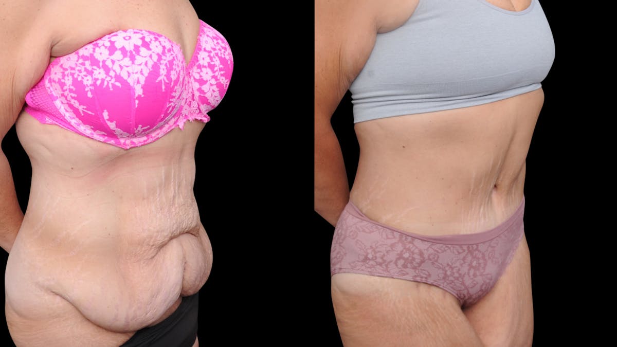 Tummy Tuck Before & After Gallery - Patient 379329 - Image 4