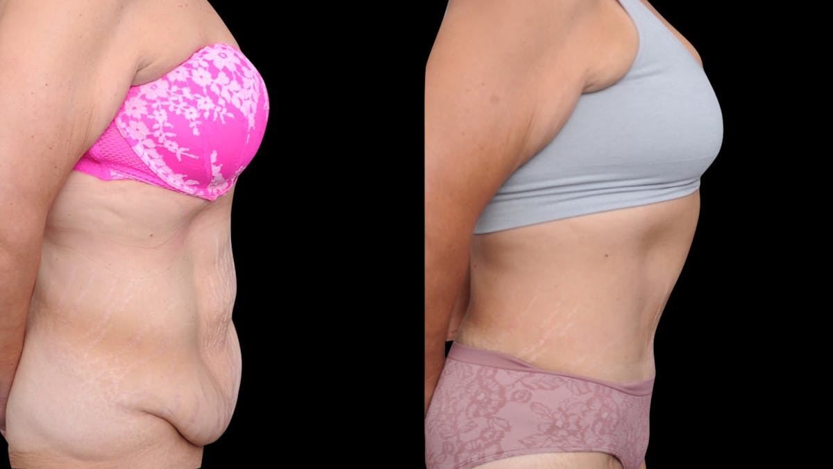 Tummy Tuck Before & After Gallery - Patient 379329 - Image 5