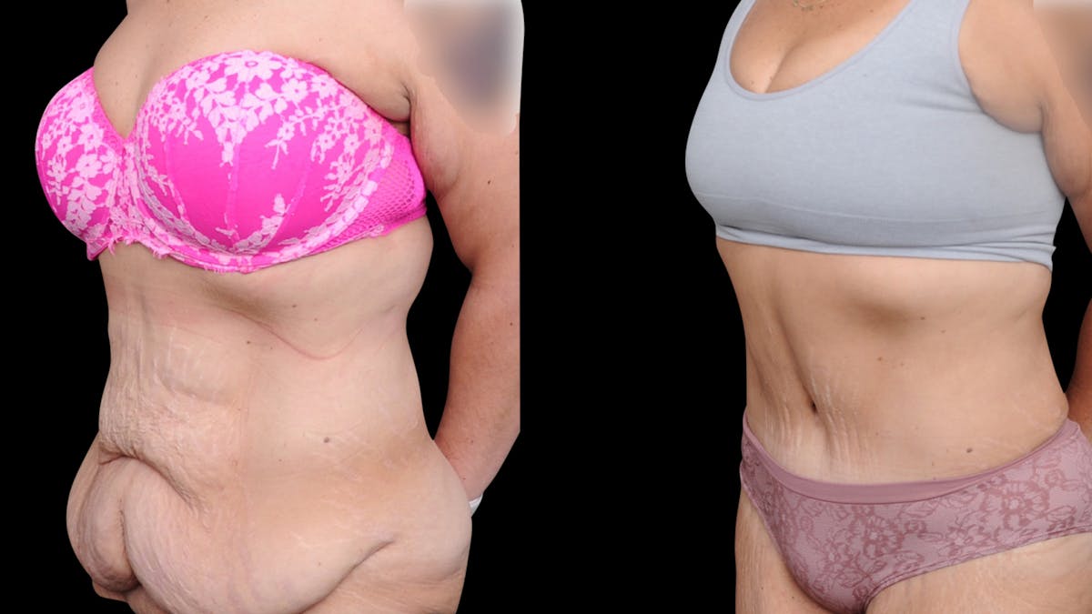 Tummy Tuck Before & After Gallery - Patient 379329 - Image 6