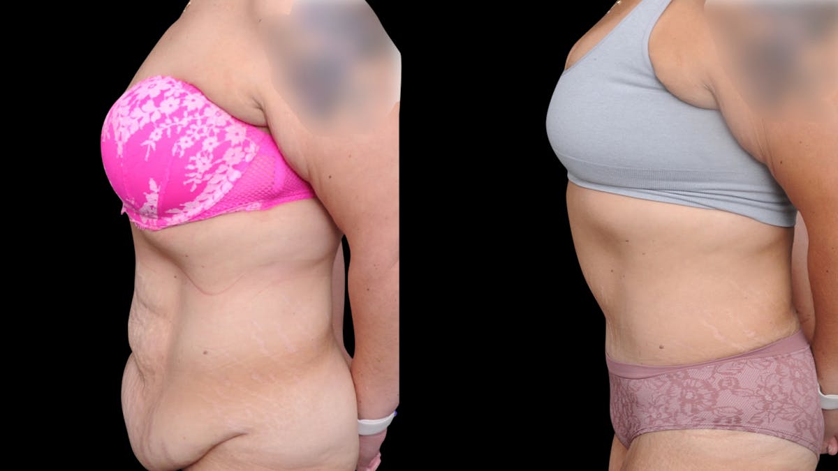 Tummy Tuck Before & After Gallery - Patient 379329 - Image 7
