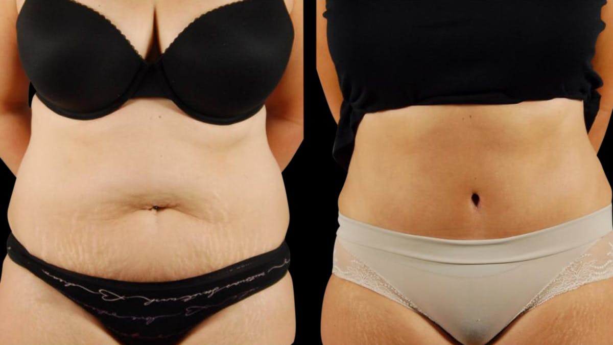 Tummy Tuck Before & After Gallery - Patient 199941 - Image 1