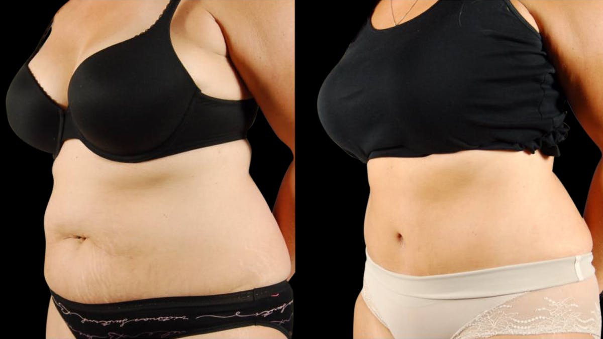 Tummy Tuck Before & After Gallery - Patient 199941 - Image 2