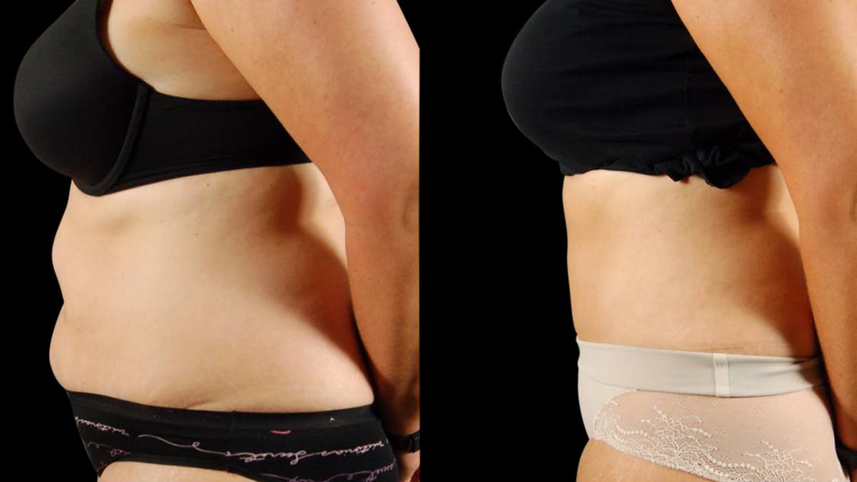 Tummy Tuck Before & After Gallery - Patient 199941 - Image 3