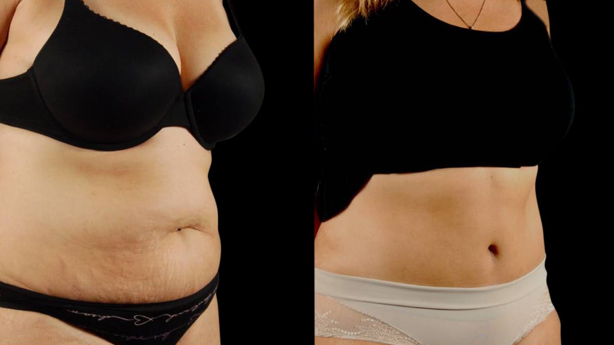 Tummy Tuck Before & After Gallery - Patient 199941 - Image 4