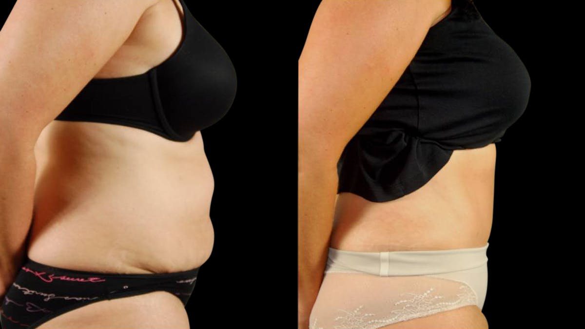 Tummy Tuck Before & After Gallery - Patient 199941 - Image 5