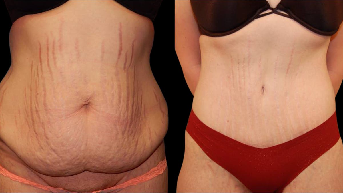 Tummy Tuck Before & After Gallery - Patient 288038 - Image 1