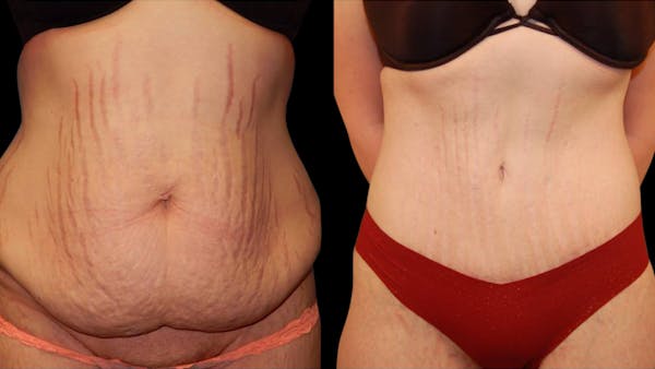Tummy Tuck Before & After Gallery - Patient 288038 - Image 1