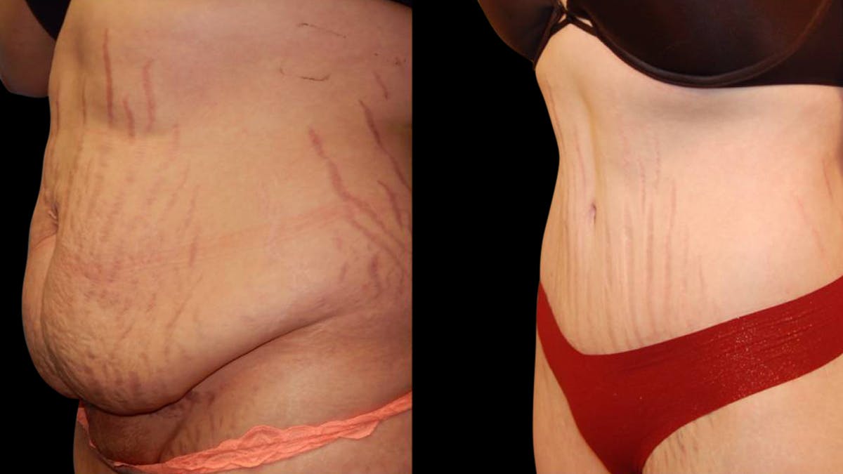 Tummy Tuck Before & After Gallery - Patient 288038 - Image 2