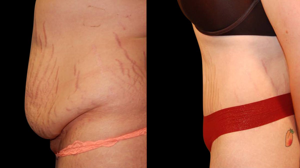 Tummy Tuck Before & After Gallery - Patient 288038 - Image 3