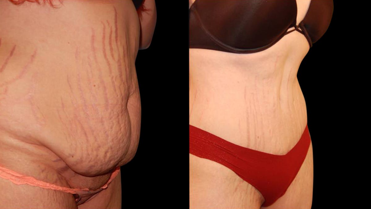 Tummy Tuck Before & After Gallery - Patient 288038 - Image 4
