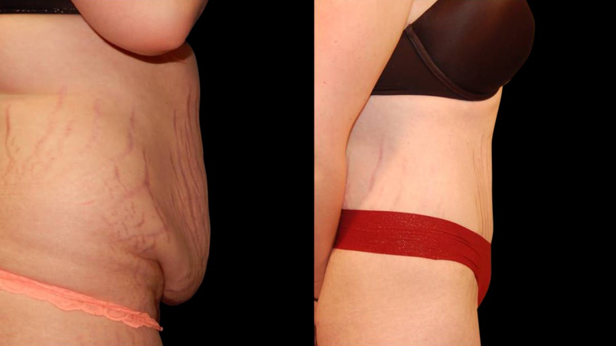 Tummy Tuck Before & After Gallery - Patient 288038 - Image 5