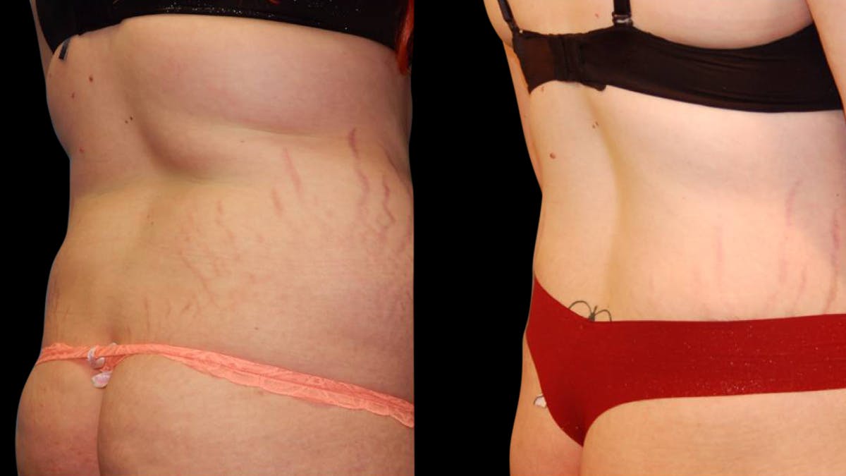 Tummy Tuck Before & After Gallery - Patient 288038 - Image 6
