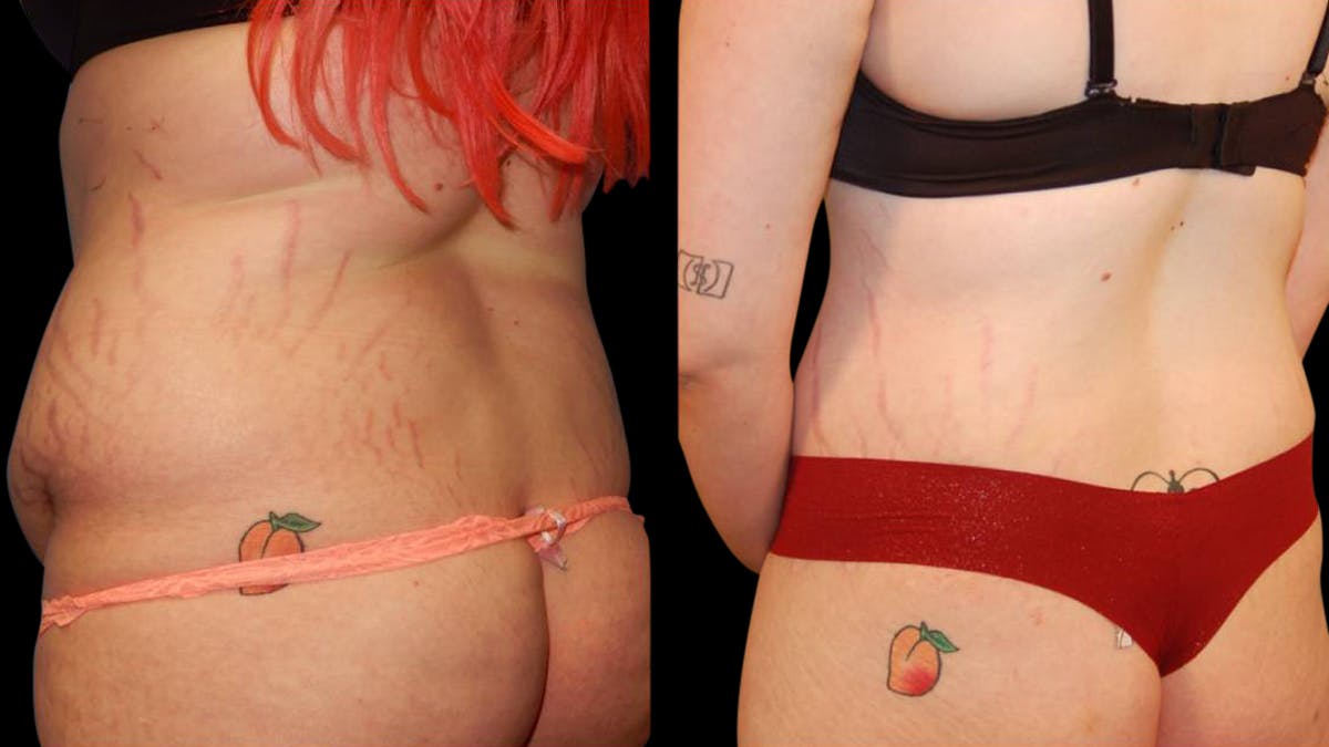 Tummy Tuck Before & After Gallery - Patient 288038 - Image 7