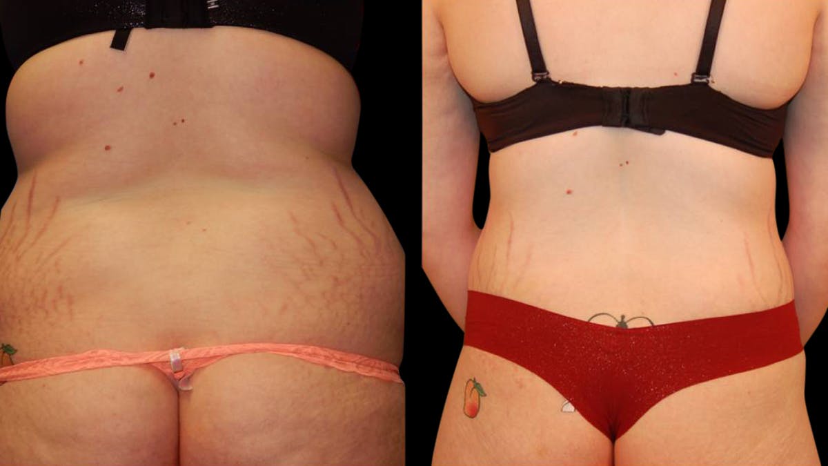 Tummy Tuck Before & After Gallery - Patient 288038 - Image 8