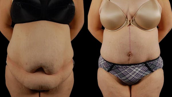 Tummy Tuck Before & After Gallery - Patient 177831 - Image 1