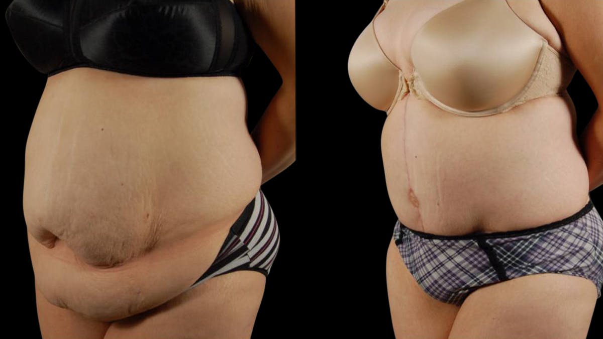 Tummy Tuck Before & After Gallery - Patient 177831 - Image 2